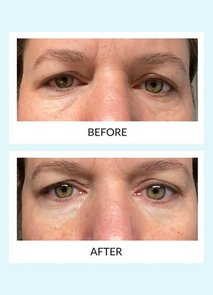 Reusable Eye Therapy Patches Solo